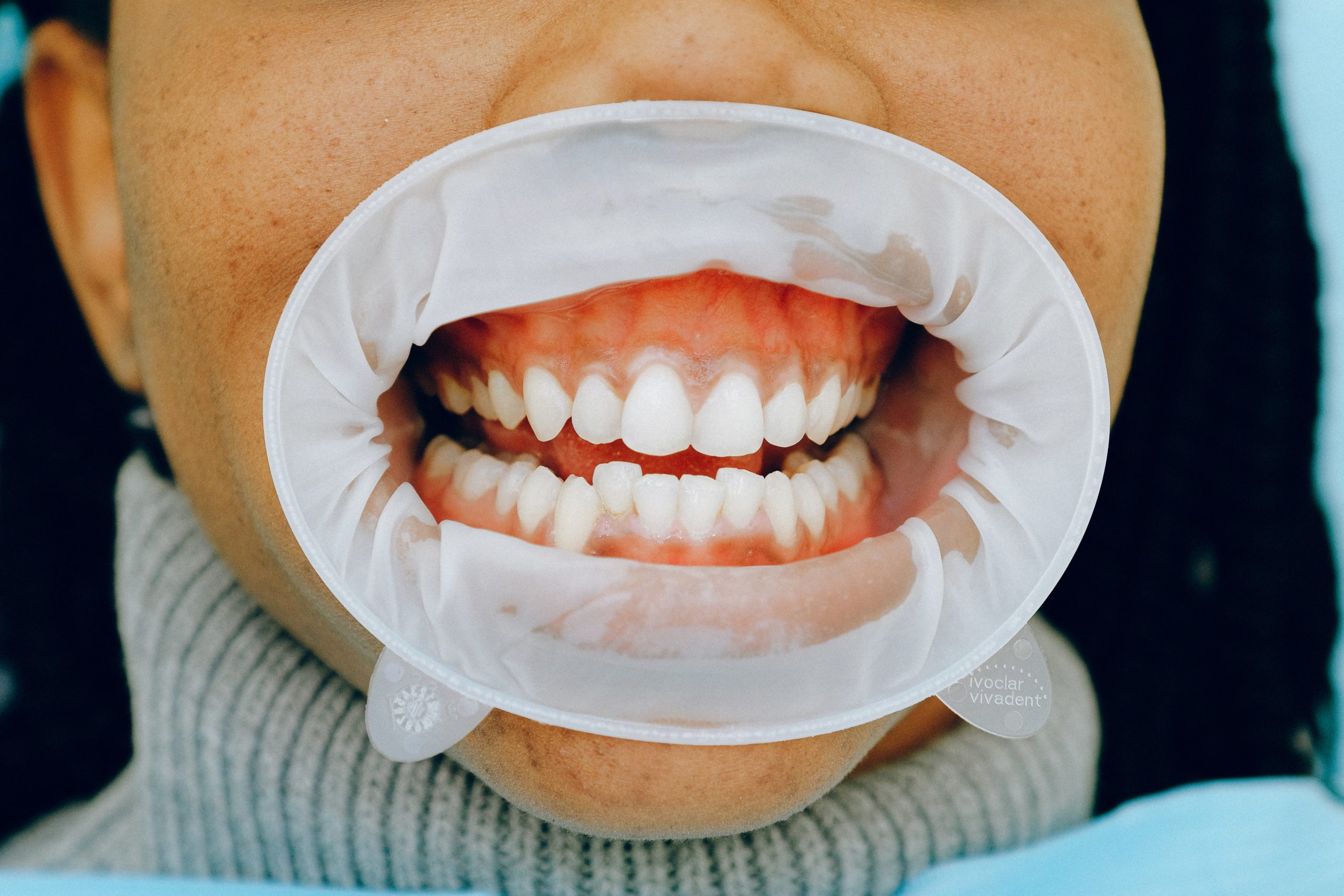 A photo of a patient wearing the dental lip device preparing to have her teeth and gums cleaned.